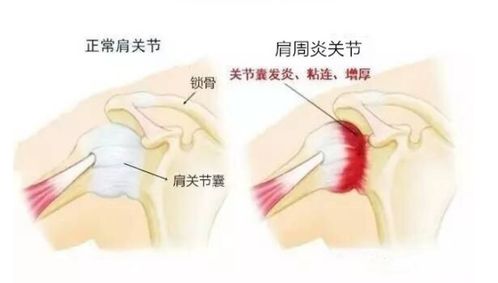 顽固性肩周炎 肩周损伤怎样免于手术尽快康复