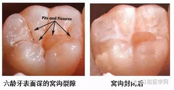 阳泉这家医院免费为全市7 9岁儿童做窝沟封闭