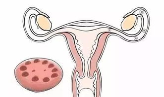 多囊卵巢综合症是怎么回事 多囊卵巢综合症是什么意思