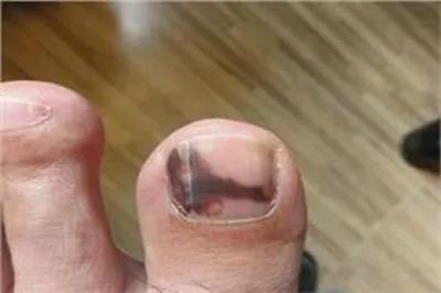 灰指甲会自愈吗,灰指甲能自愈吗?