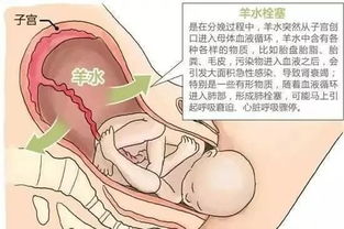 原创产妇有这5个特征，很容易发生羊水栓塞！特别第4种，对子宫伤害大