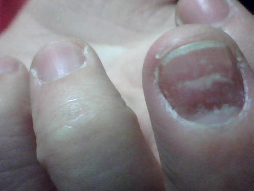 我的手指甲中间有白色的横纹是怎么回事呢 
