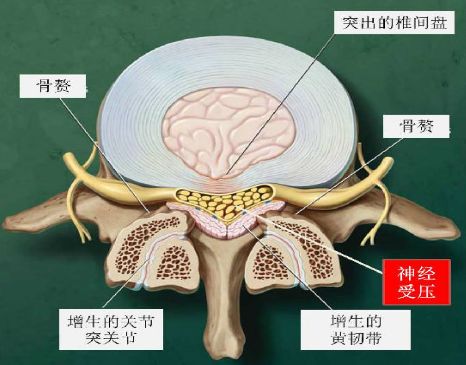 腰椎管狭窄用手术治疗效果好吗