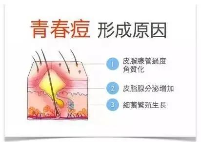 粉刺的成因(粉刺行成的原因)