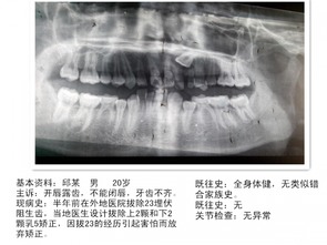 正畸之扩弓与拔牙 一