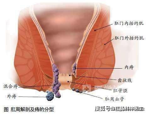 痔疮是怎么来的 医生 让我来告诉你它的前世今生