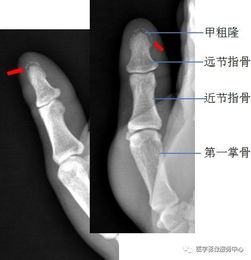 右手拇指末节骨折图片 搜狗图片搜索