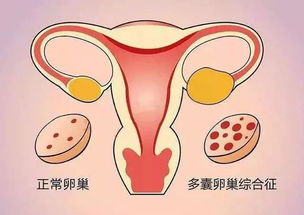 患上多囊卵巢综合征？食疗助好“孕”