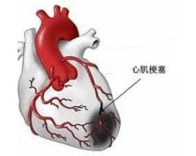 急性心梗冠脉支架术 有关注意事项