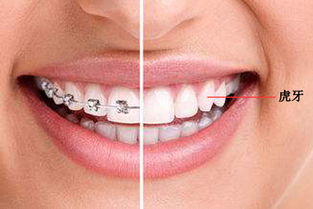 虎牙和普通牙齿有什么区别 