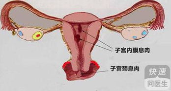 子宫内膜息肉的症状有哪些(子宫内膜息肉的临床症状)