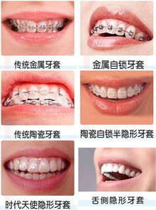 传统透明矫治器陶瓷牙套 信息图文欣赏 信息村 K0w0m Com