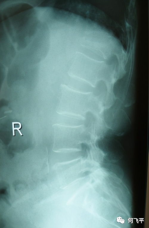 L1椎体压缩性骨折是一种常见的脊柱骨折类型，其特征是L1椎体的高度和宽度受到压缩，导致脊