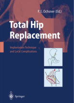 post op total knee replacement,Understanding Post-Op Total Knee Replacement