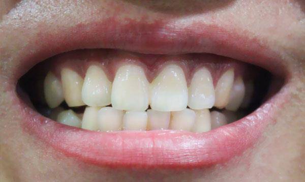 日本人牙齿不整齐(日本人牙齿不整齐是遗传吗)