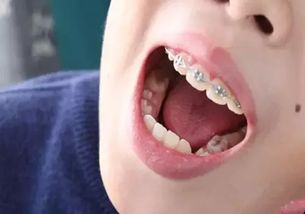 牙齿矫正时期如何护理 不得不注意的几大问题