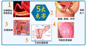 痔疮危害大,盘点正确防治方法