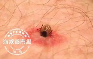 恐怖 蜱虫钻进福州7岁女孩眼睑 牢牢趴着吸血 