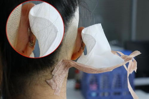 夫妻吵架意外咬伤耳朵,女子赴高尚医疗做耳修复手术