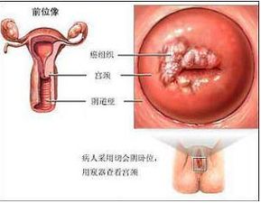 宫颈癌会遗传给孩子吗