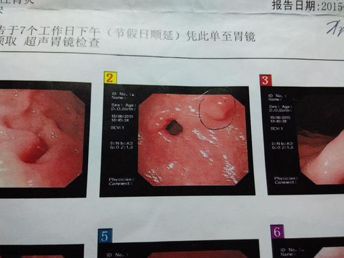 胃病一定要做胃镜检查吗 若出现这4个现象,劝你还是别再 拖 了