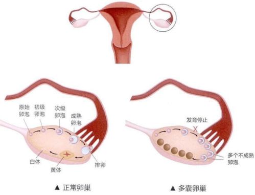 得了多囊也没有治疗就怀孕了，胎儿质量会好吗(多囊卵巢没治疗怀孕了孩子能要吗)