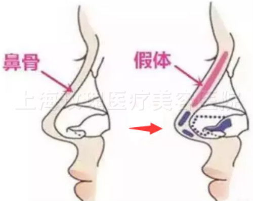 假体隆鼻的假体会移动吗