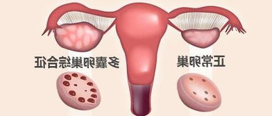 多囊卵巢综合症能怀孕吗，多囊卵巢能自然怀孕吗