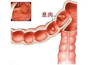 结直肠多发性息肉严重吗(结直肠多发息肉怎么治)