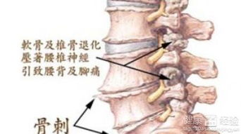 颈椎骨质增生偏方