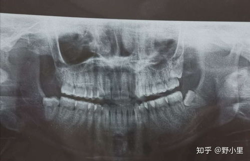 北京口腔医院拔智齿攻略 