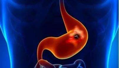 浅表性胃炎如何预防