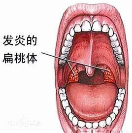 扁桃体肥大图片 