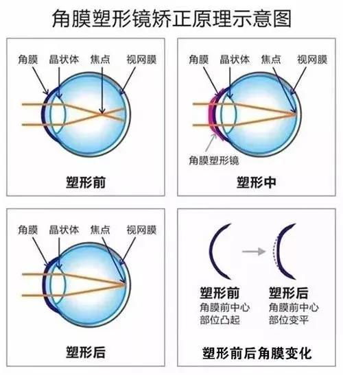 五分钟告诉你什么是角膜塑型镜