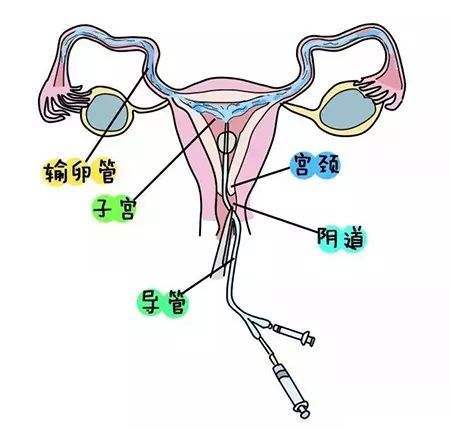 输卵管造影怎么做，输卵管造影检查怎么做