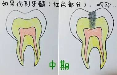 有些蛀牙,为什么不能直接一次性补好 