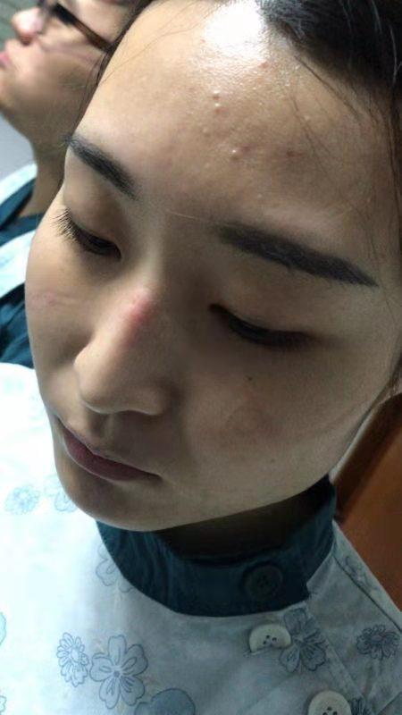 郑州大学第二附属医院赴武汉医疗队员 脸上的血痕是奋斗的印记