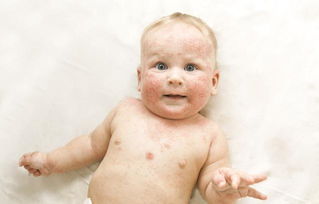 婴儿湿疹症状图片？七种区别教你区分宝宝湿疹和热疹