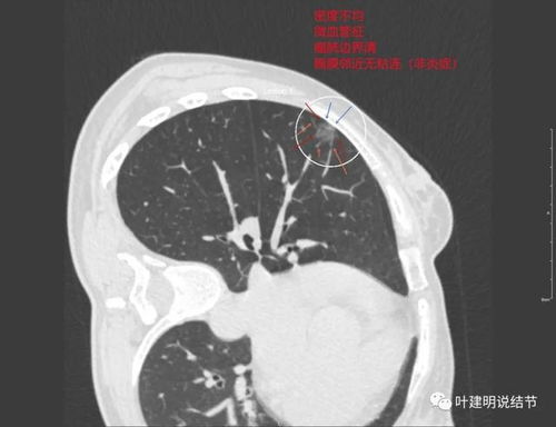 两肺多达9处结节,是否要手术 临床如何决策