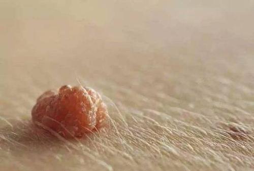 皮肤上长出的 小肉球 是什么 你知道吗