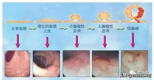 做一次肠镜,到底能管几年平安 是17年还是5年