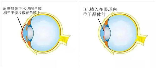 为什么说ICL晶体植入术是可以 后悔 的近视手术