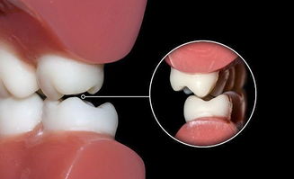 牙髓炎图片 一般牙髓炎该如何预防？ 
