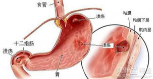 胃溃疡怎么处理