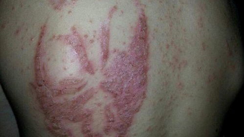 英国男孩在埃及纹身严重过敏 后背长疱疹