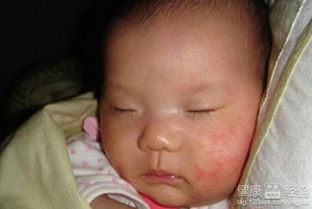 痱子湿疹？孩子身上有红斑点,痱子还是湿疹分不清,这个怎么区分啊