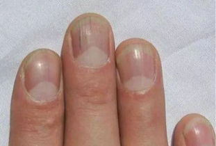 手指甲无 月牙 月牙少 代表身体不健康 月牙越大越好
