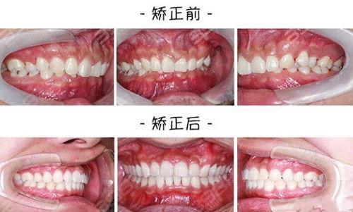 深覆合怎么矫正 通过深覆合一度二度三度照片来解析