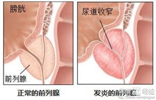 真菌性前列腺炎原因及治疗方法