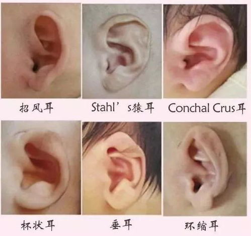 北斗星耳畸形康复中心丨你所不知道的耳畸形,然来有这么多种类